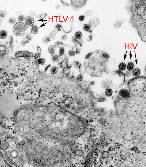 Microscopic view of HTLV 1 and HIV Particles